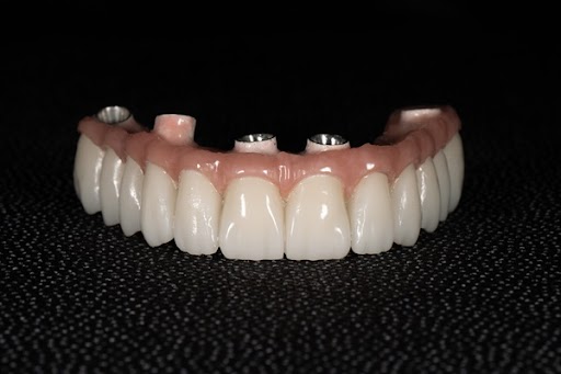 When All On   Implants Are The Best Option For Smile Restoration