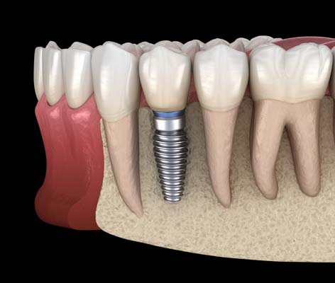 What To Expect During And After A Bone Grafting Procedure