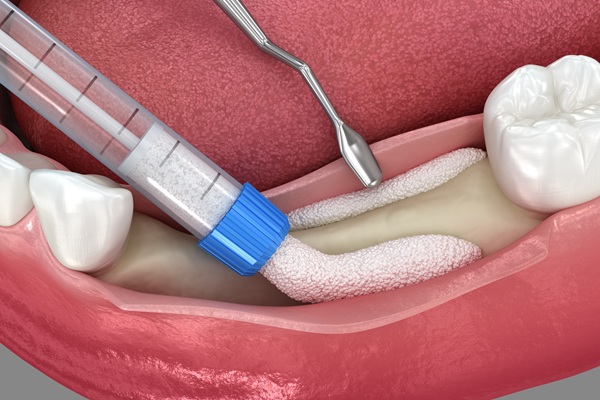 What You Should Know About Bone Grafting