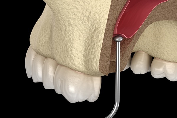 The Importance Of A Sinus Lift Procedure