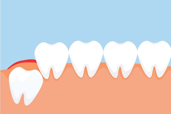 At What Age Should You Have Your Wisdom Teeth Out?